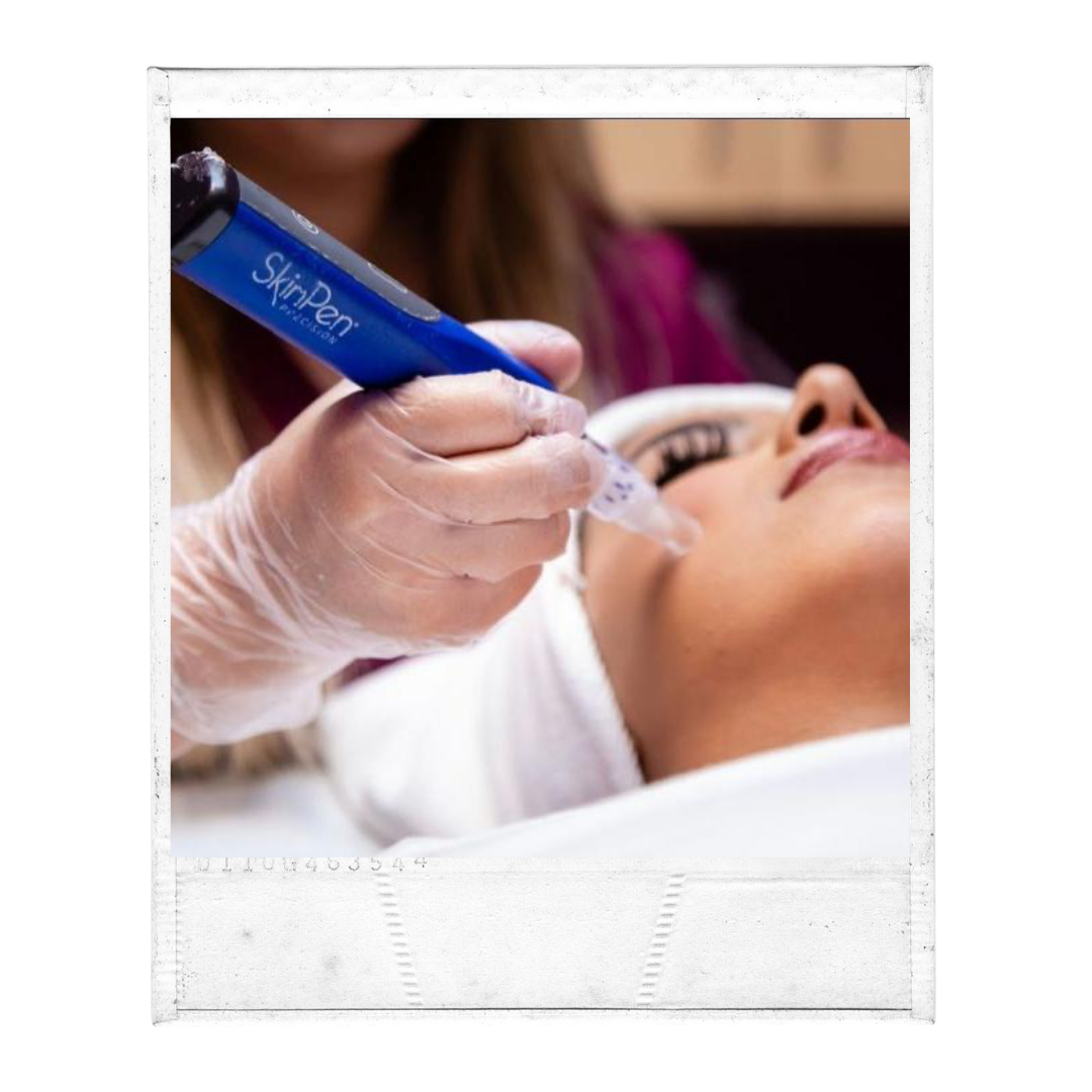 Microneedling Flawless Skin Center
