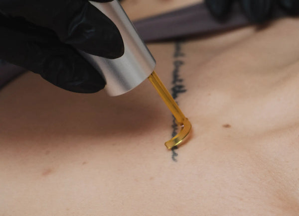 Laser Tattoo Removal