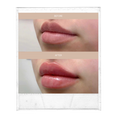 Load image into Gallery viewer, Lip Filler (your choice of: Juvederm ultra/ultra plus, Restylane Kysse, Restylane Refyne/Defyne, 1ml)