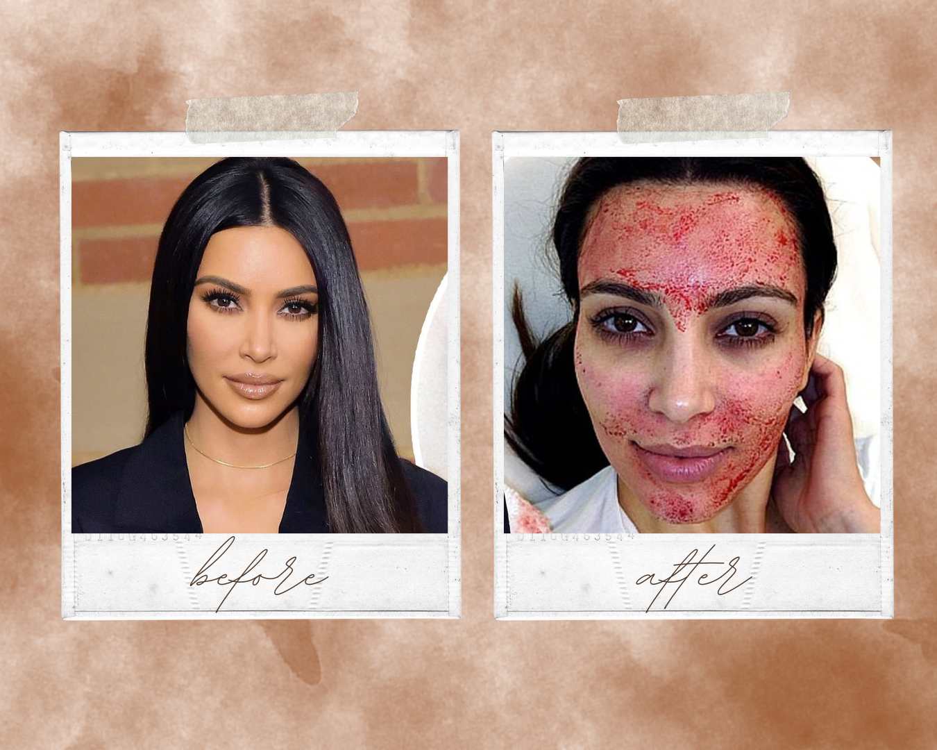 Platelet Rich Plasma (PRP) Therapy: The Vampire Facial Used by the Stars