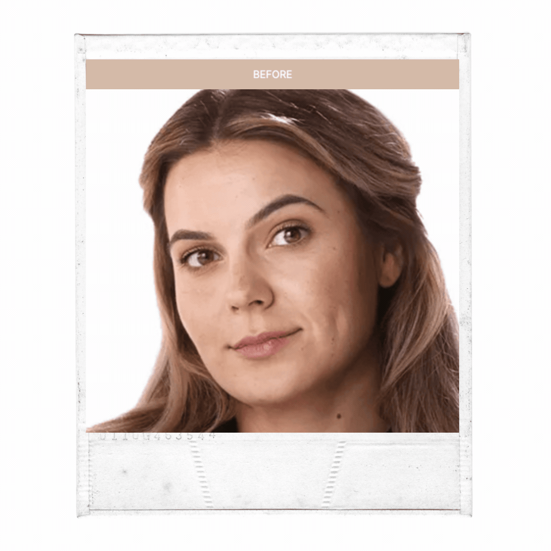 Cheek Filler/Contour (Your choice of 2ml’s of: Juvederm Voluma, Restyl ...