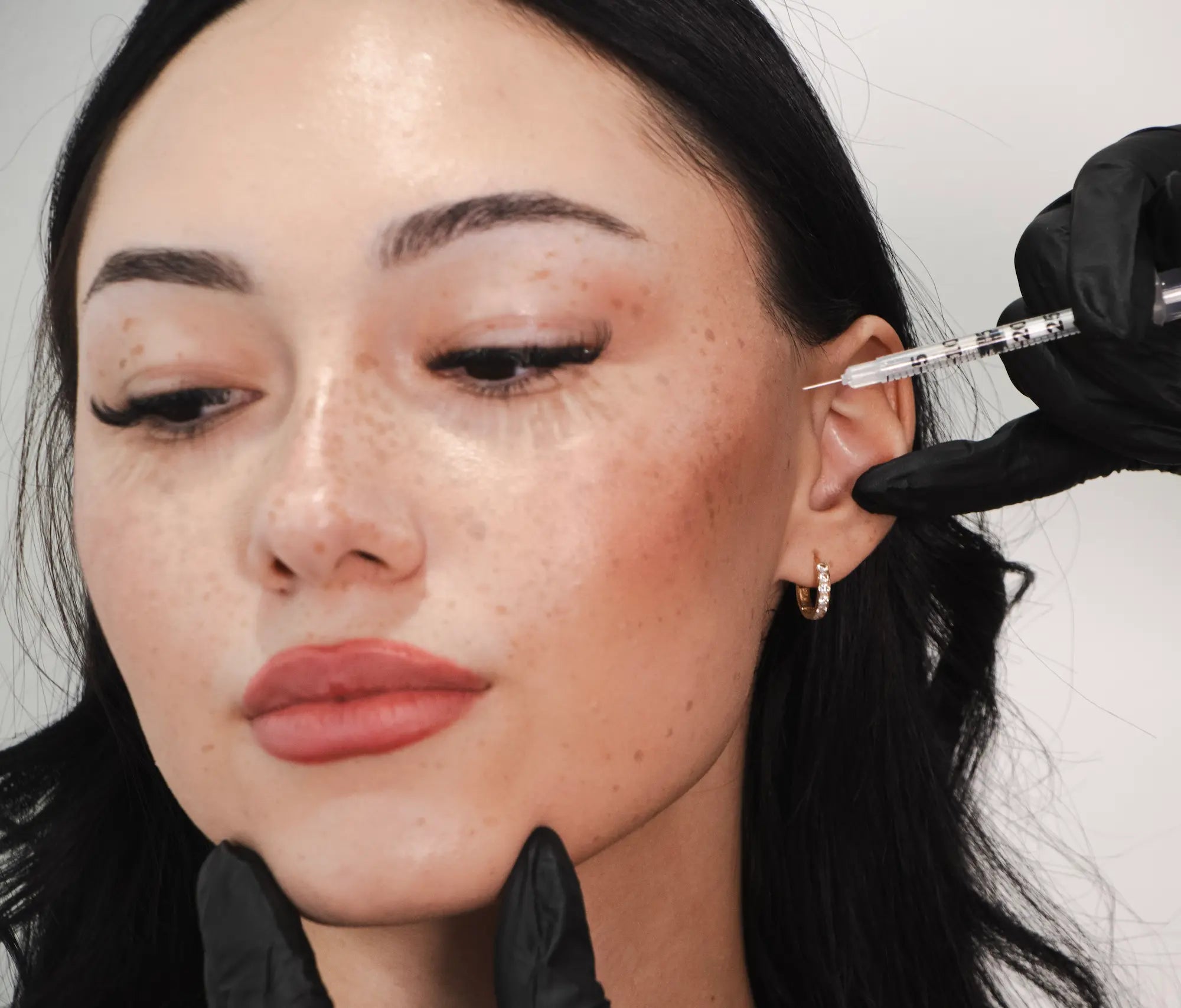 Dermal Fillers