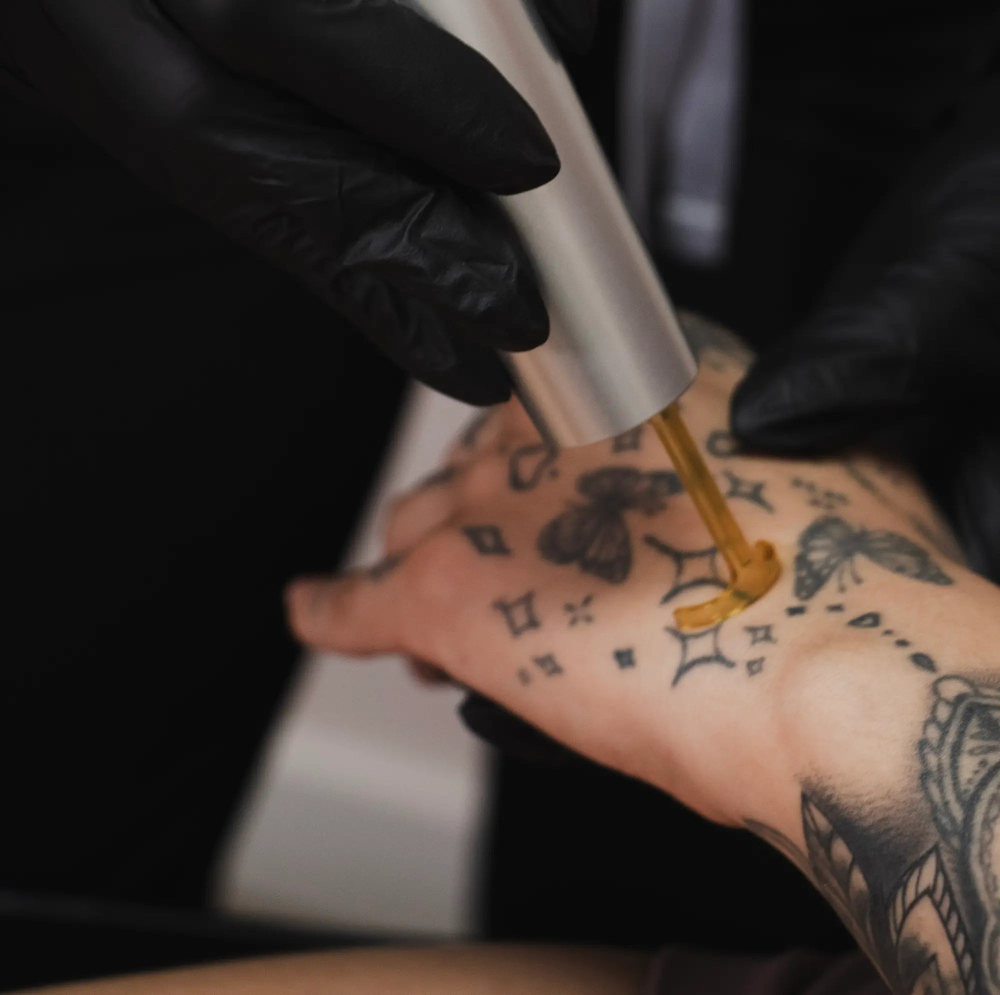 Laser Tattoo Removal in Los Angeles. Expert Care, Real Results