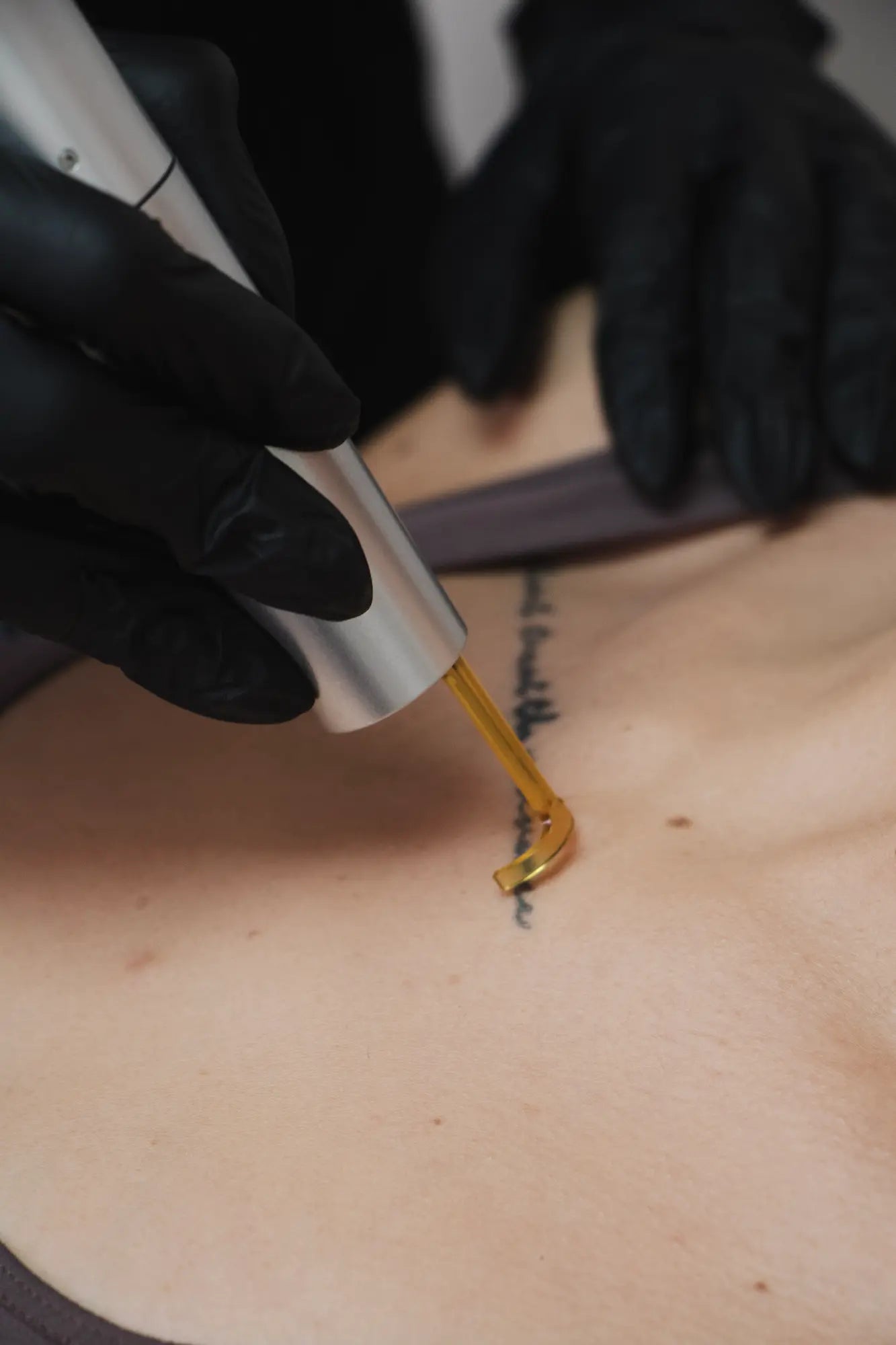 What Tattoo Removal Actually Does
