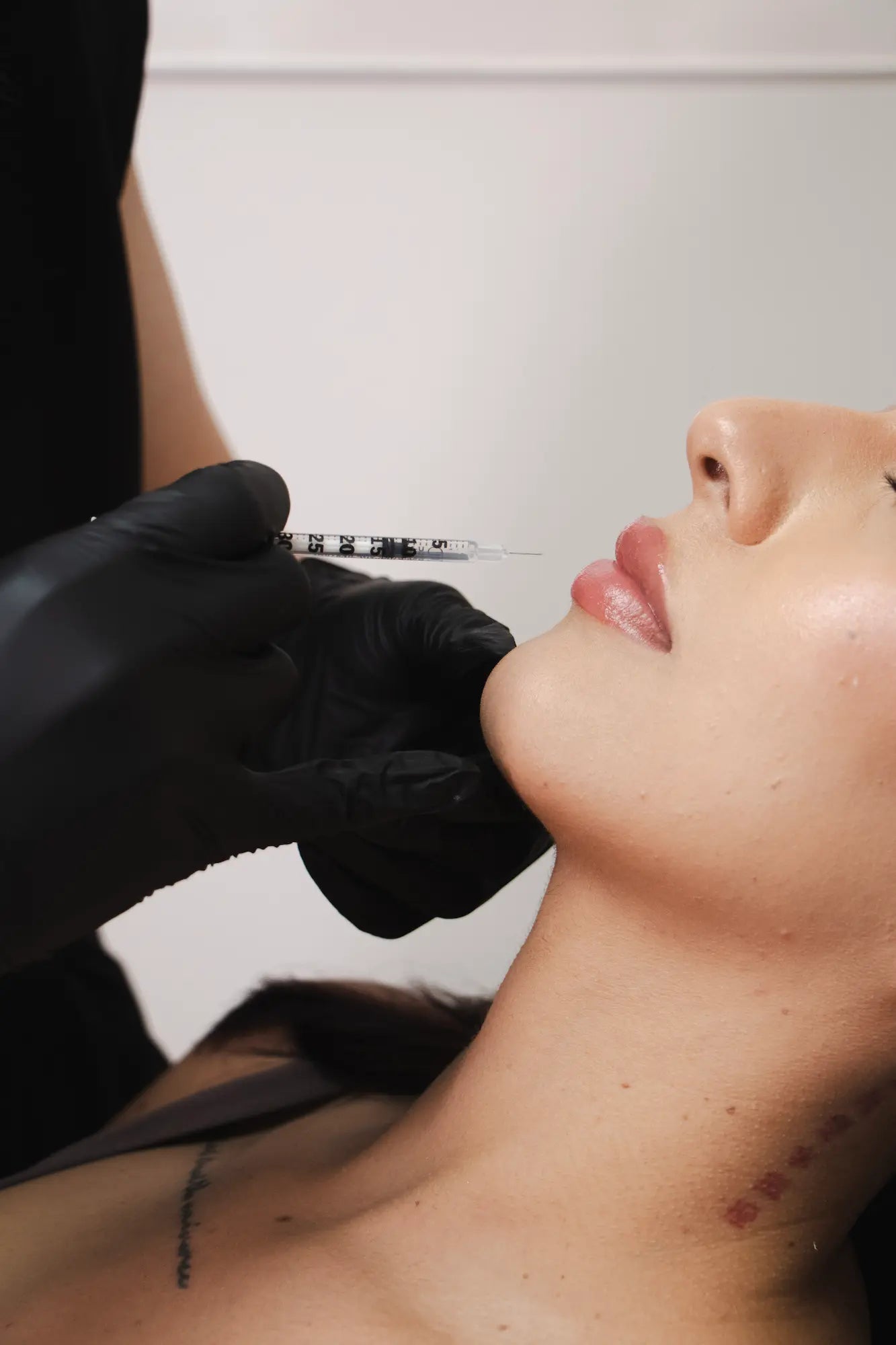 Dermal Fillers