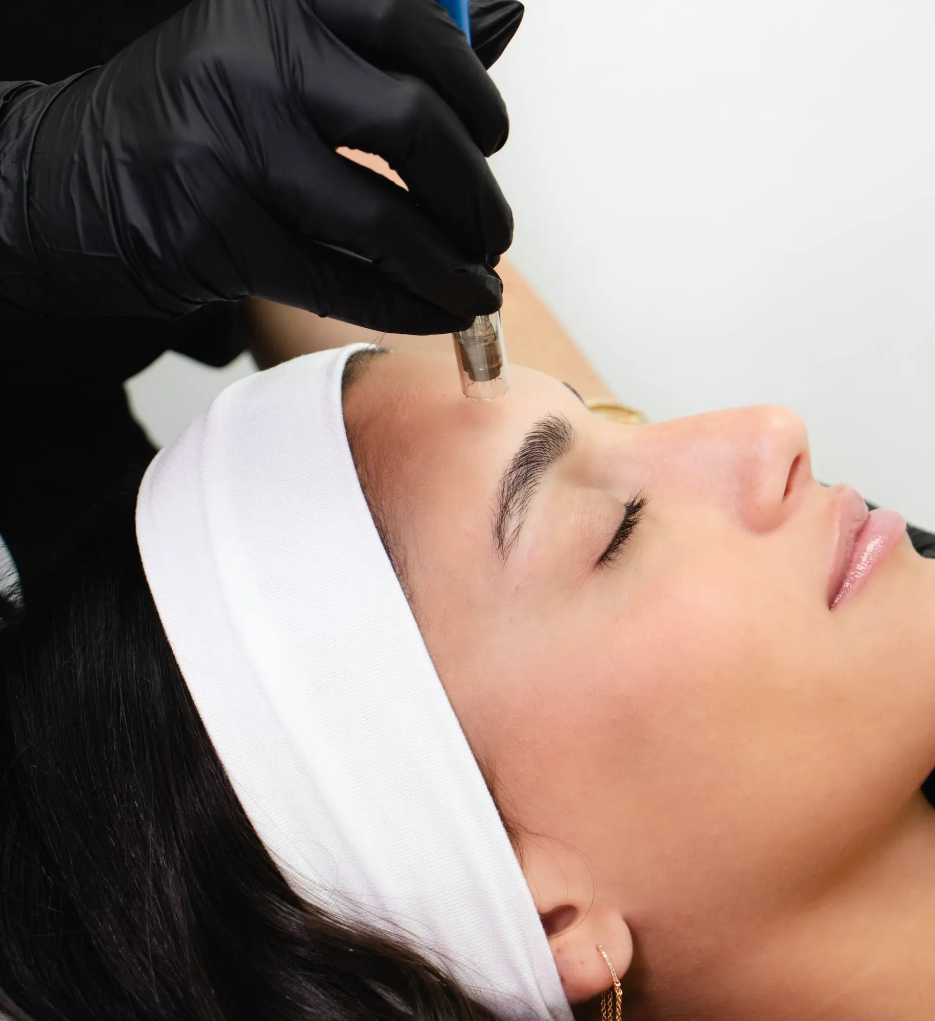Microneedling in Los Angeles Expert Care, Natural Results