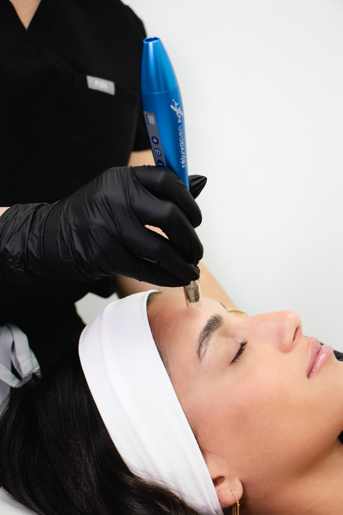 Microneedling in Los Angeles Expert Care, Natural Results