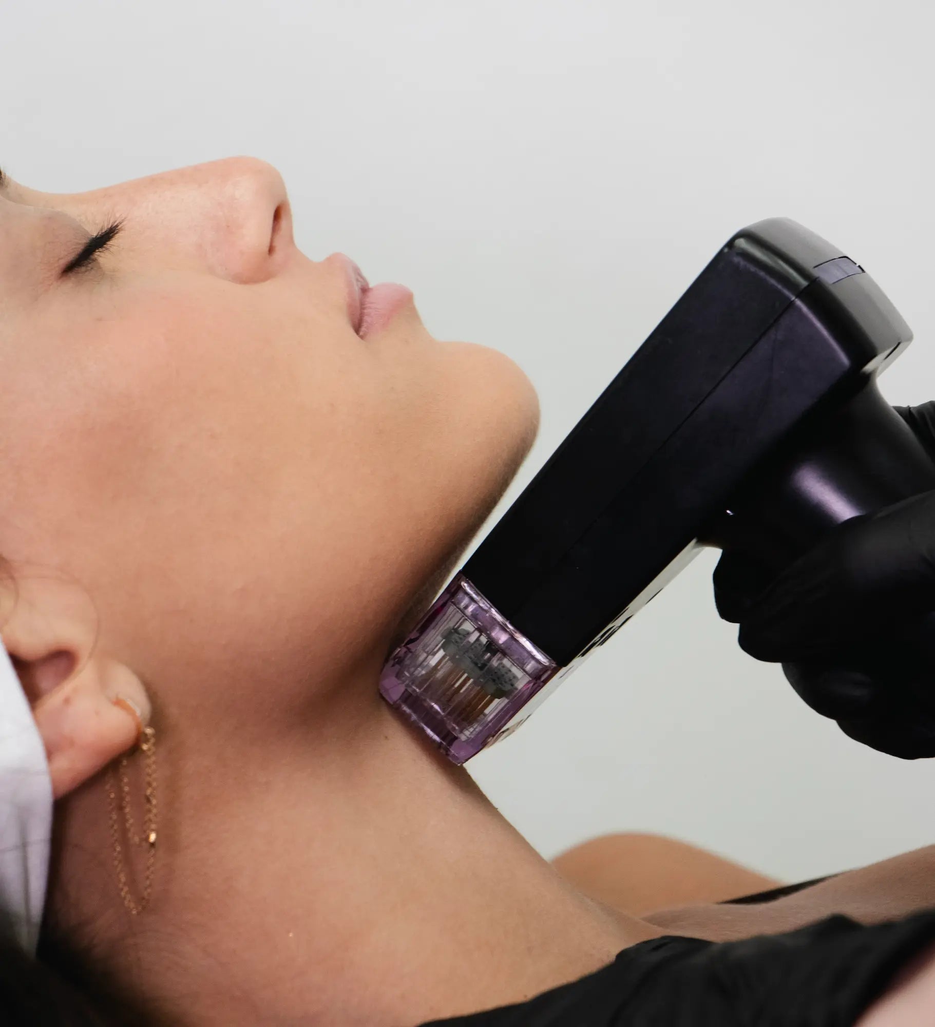 Morpheus<i>8</i> in Los Angeles Expert Care, Natural Results