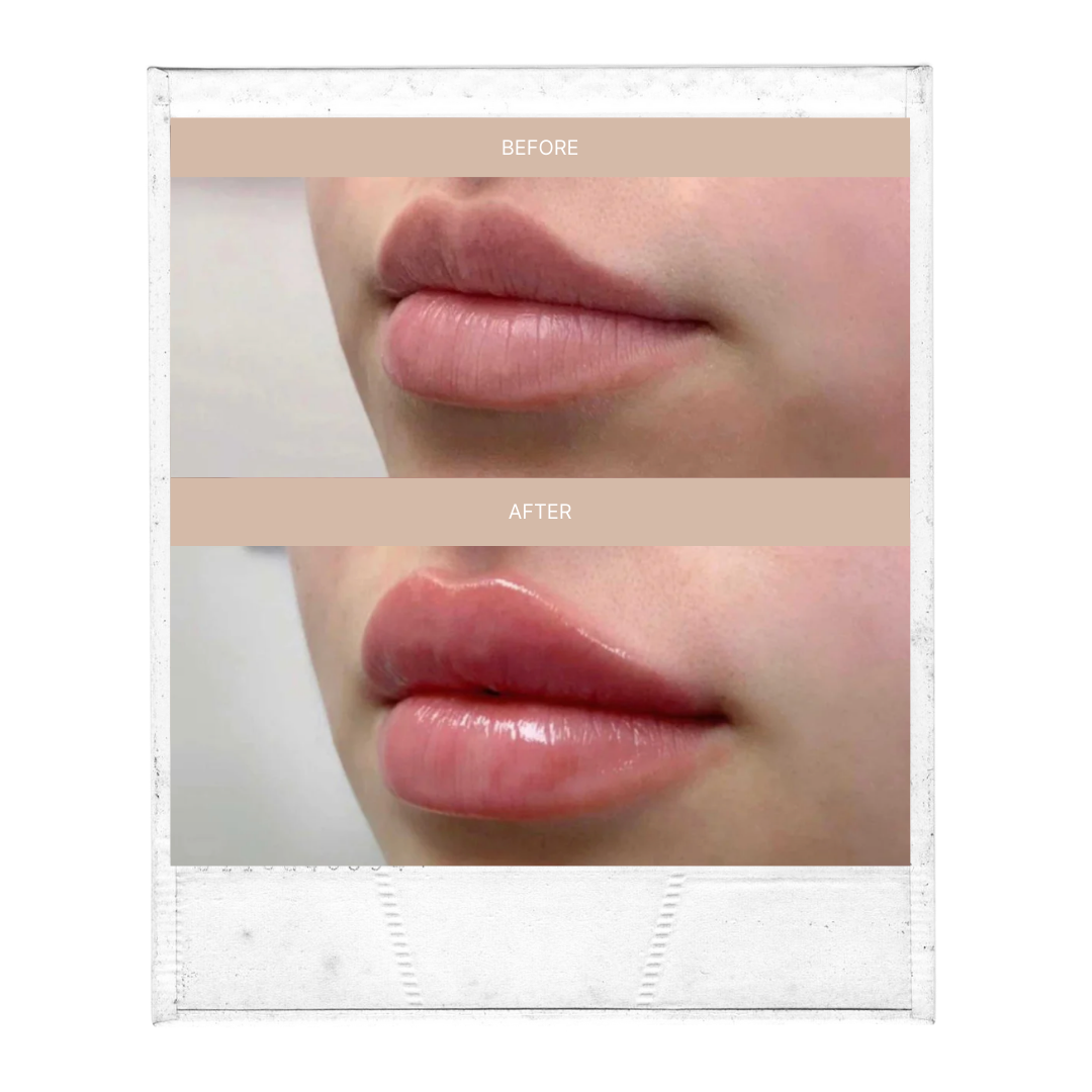 Lip Filler (your choice of: Juvederm ultra/ultra plus, Volbella, Vollure, Restylane Kysse, Restylane Refyne/Defyne, 1ml)