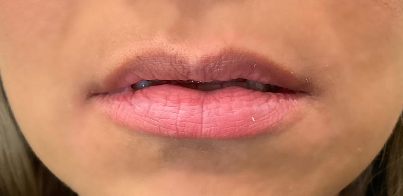 Before treatment