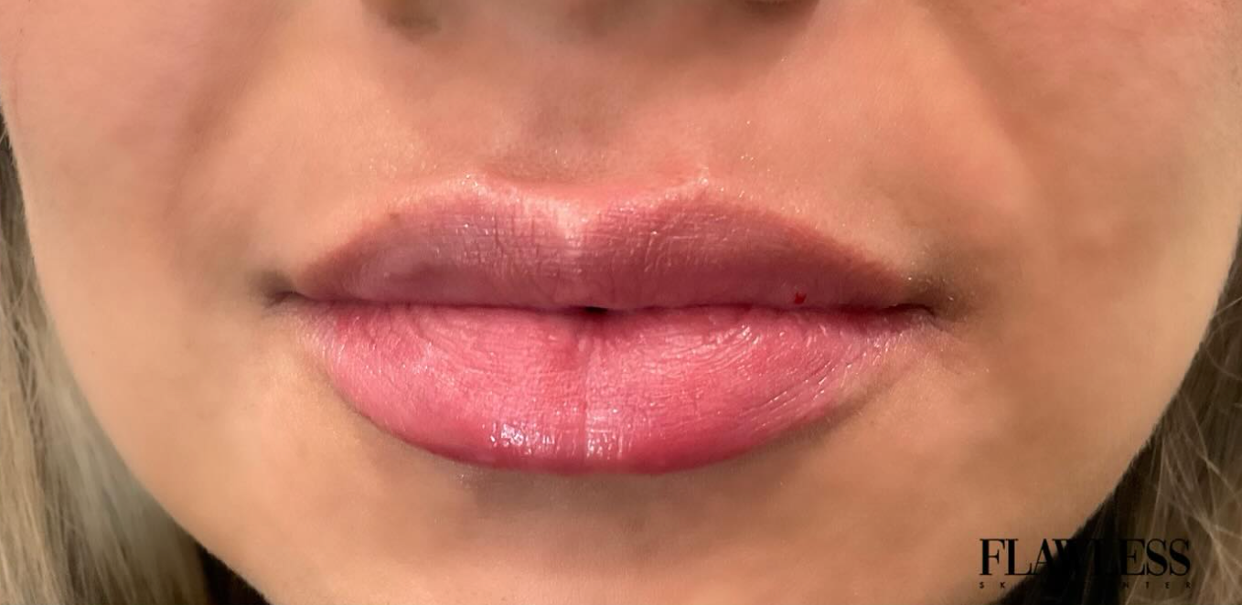 After treatment