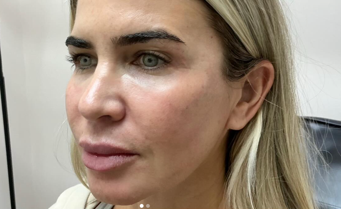 After treatment