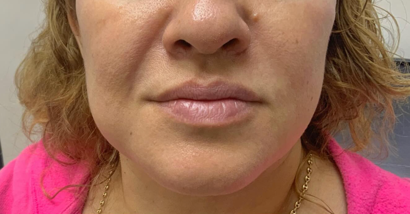Before treatment
