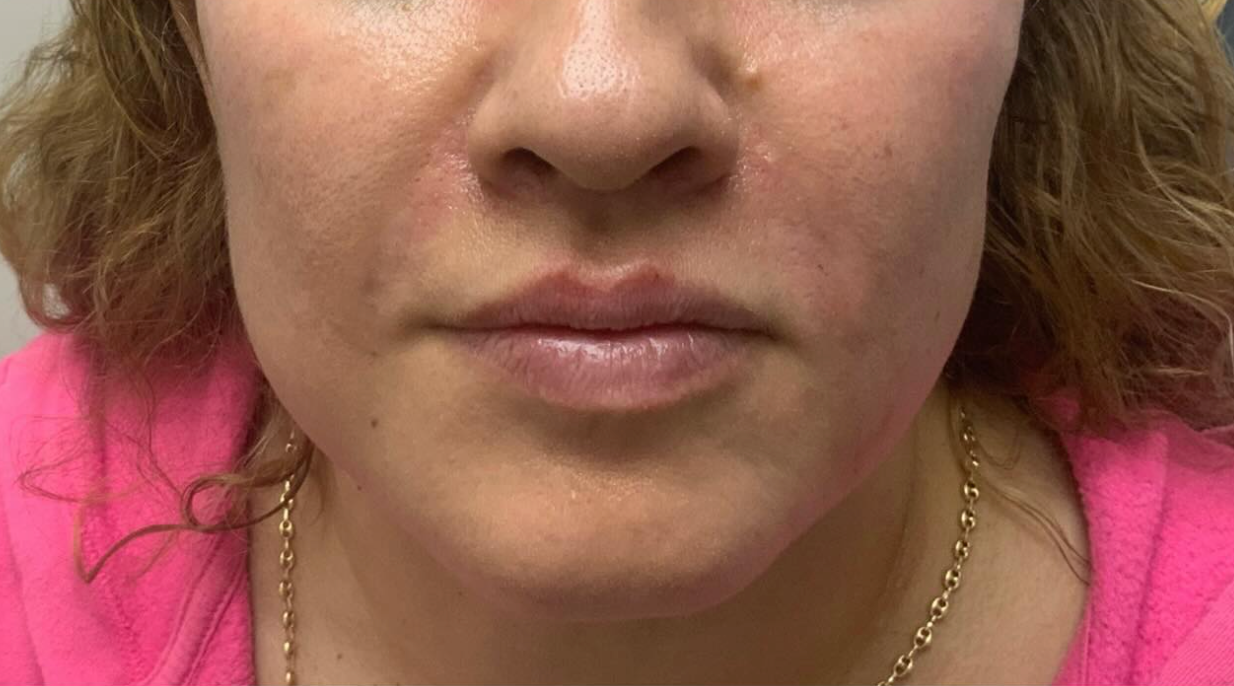 After treatment