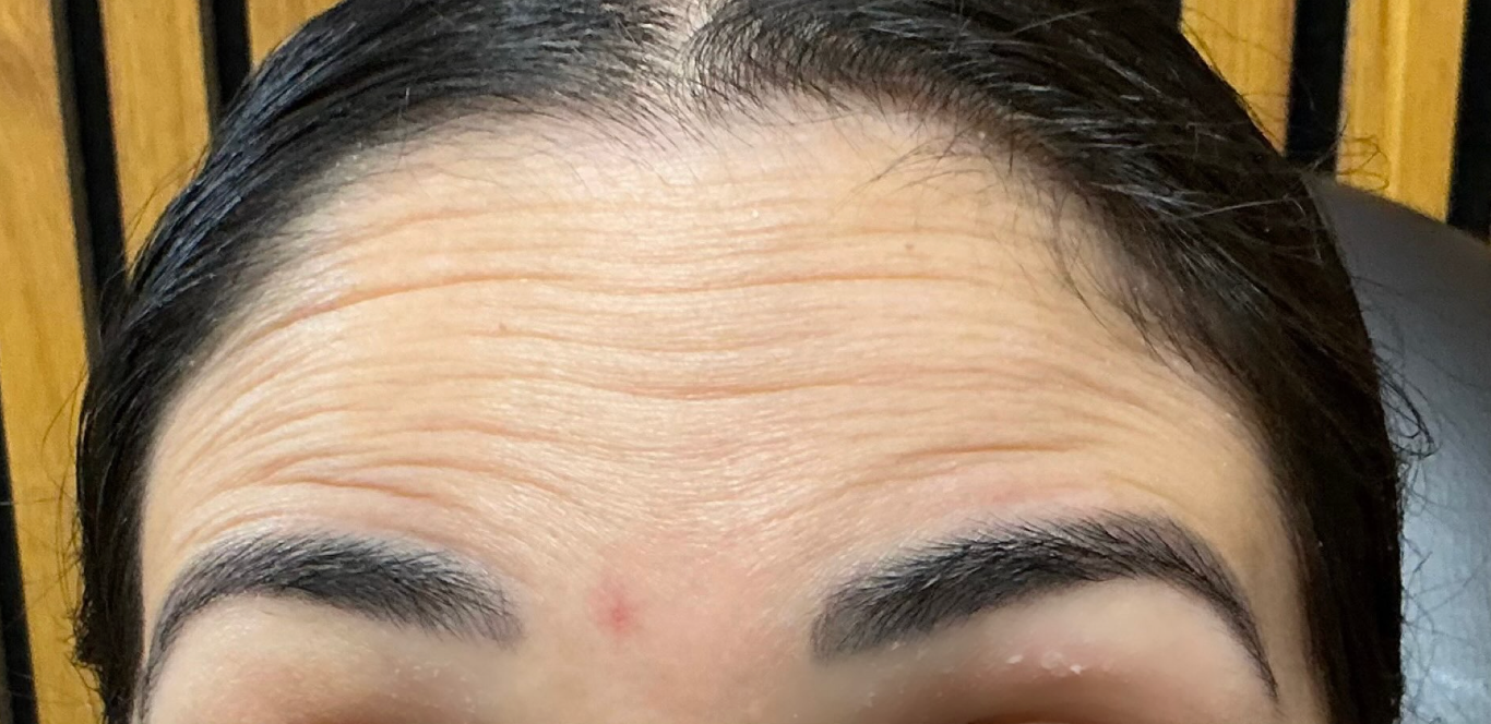Before treatment