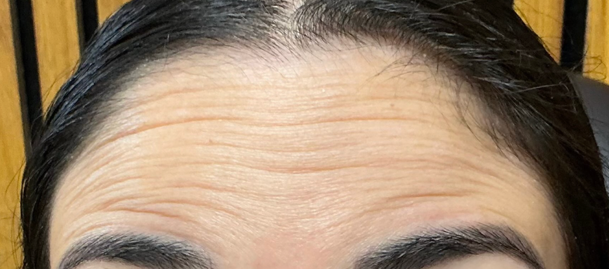 Before treatment