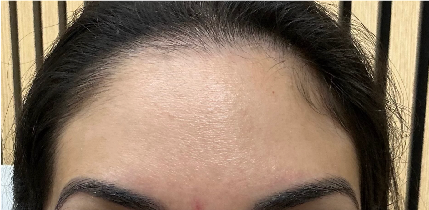 After treatment